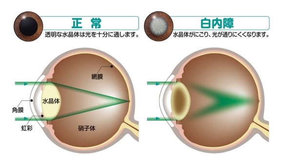 白内障の原因とは？